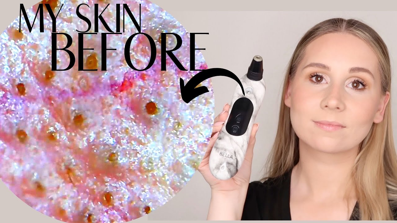 OMG CANT BELIEVE THESE RESULTS! Spa Sciences Wet Dry Microdermabrasion *Close Up Results*