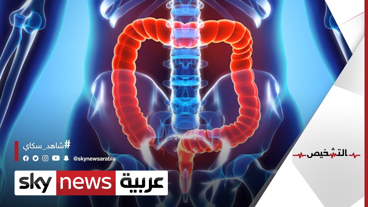 طرق حديثة تكشف عن سرطان القولون والمستقيم | #التشخيص