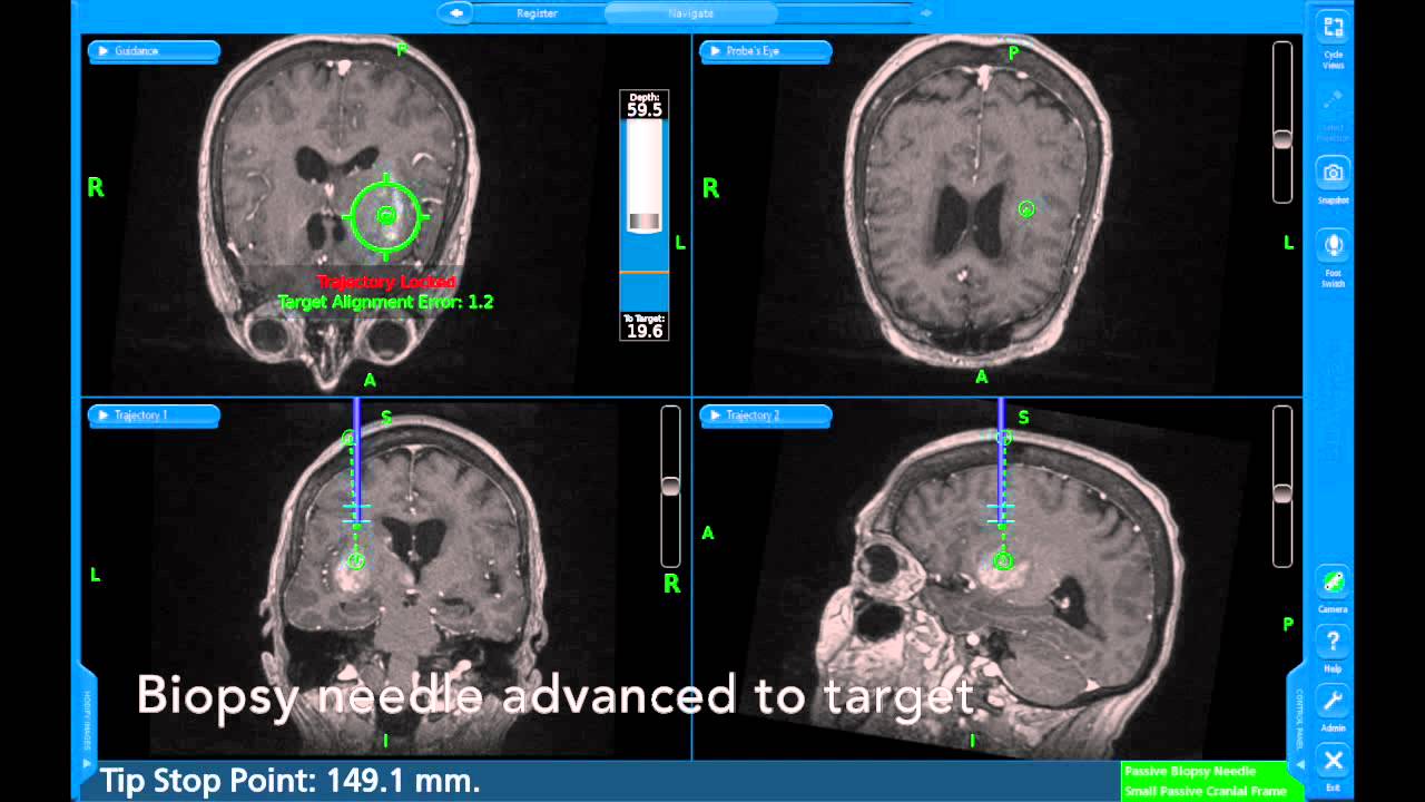 Insular high grade glioma--stereotactic biopsy