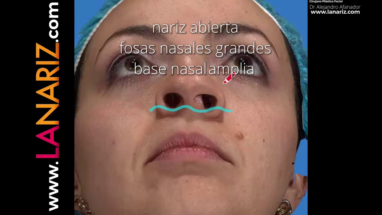 Nariz ancha cómo se estrecha?
