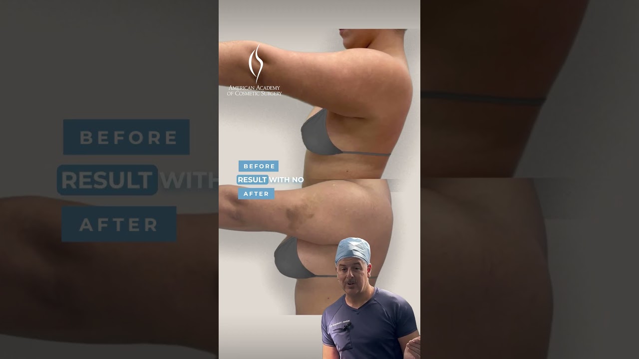 Transaxillary Mastery by Dr. Rodriguez #cosmeticsurgery #breastaugmentation #medicaleducation