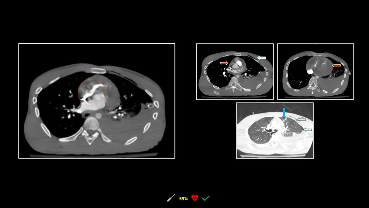 Pulmonary Granulomatous & Cavitary Lesions | Free Radiology CME