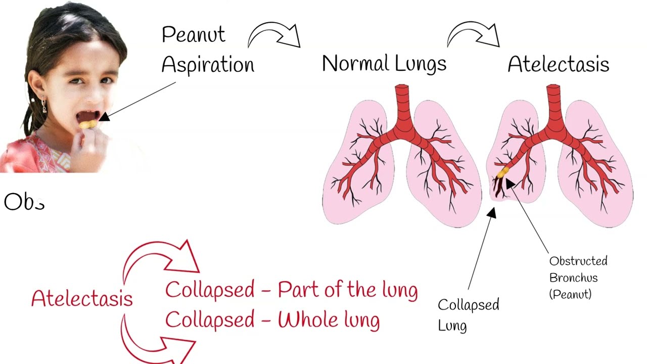 Atelectasis - signs and symptoms. Mechanism of  atelectasis, explained simply