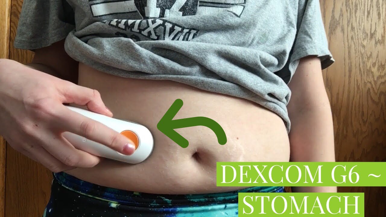 DEXCOM G6 INSERTION (STOMACH)