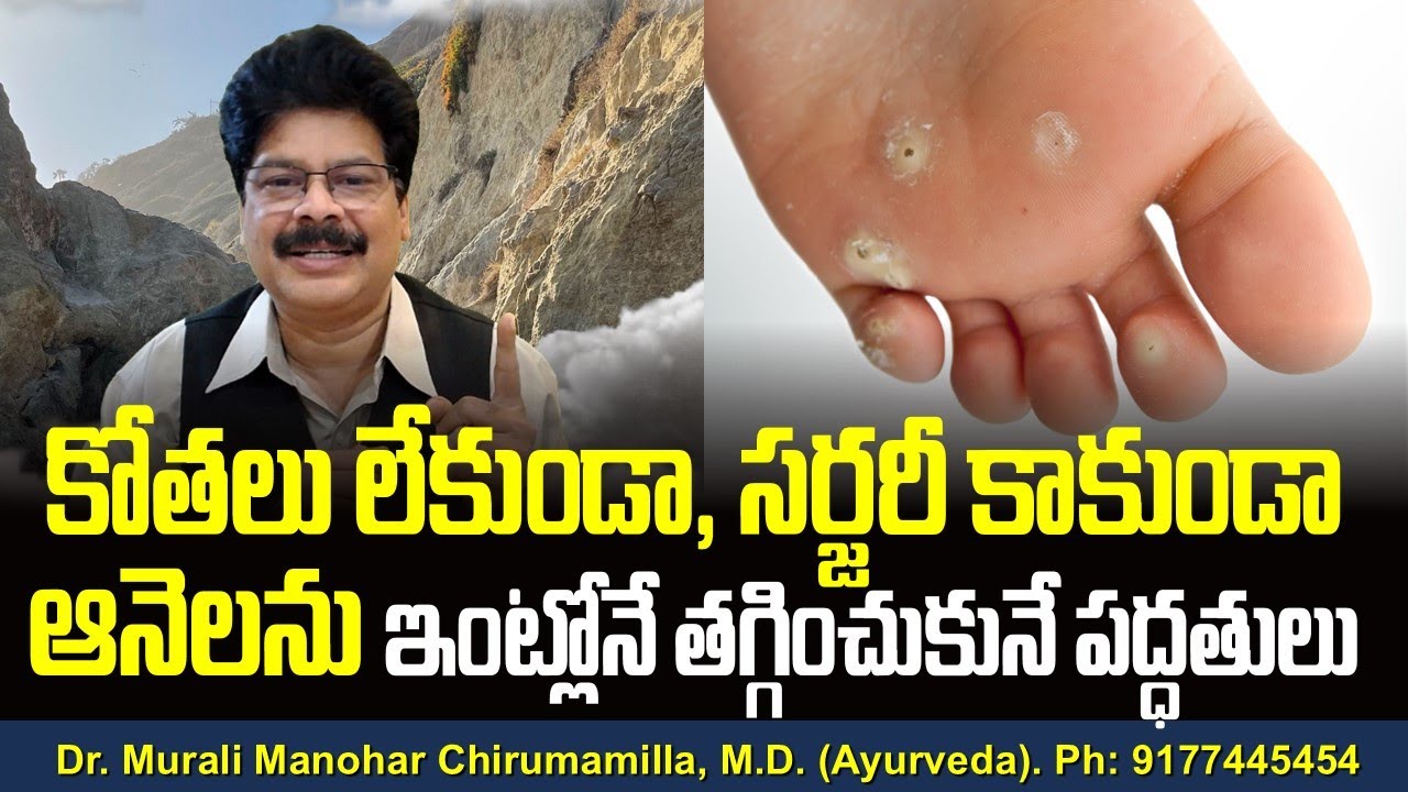 కోతలు లేకుండా, సర్జరీ కాకుండా ఆనెలను ఇంట్లోనే తగ్గించుకునే పద్ధతులు! Sure Remedies for Corns. #Facts