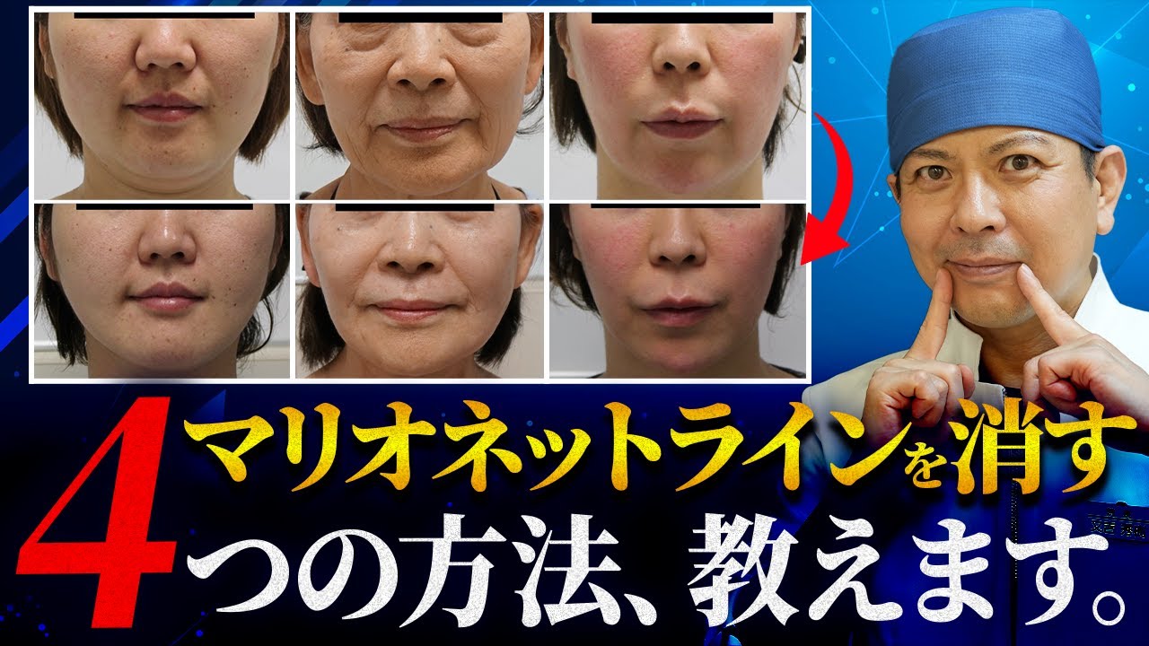 そのマッサージ、意味ないです。口元が劇的に若返る真のマリオネットラインの消し方をプロが解説します。
