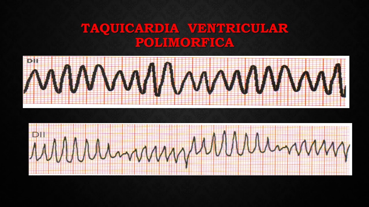 23. TAQUICARDIA VENTRICULAR