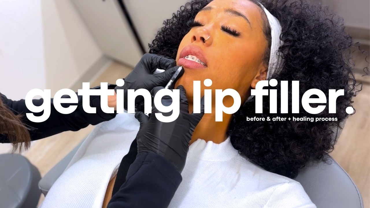 FIRST TIME GETTING LIP FILLER + GUMMY SMILE BOTOX 💉✨ | Honest Experience, Pain Level & Before/After