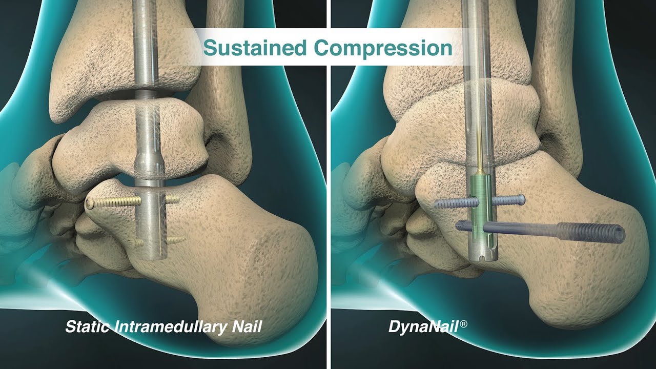 MedShape DynaNail&reg; TTC Fusion System - Animation