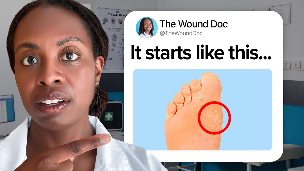 7 Signs of Diabetic Feet You Shouldn’t Ignore: Doctor Explains What to Look For Before It’s Too Late