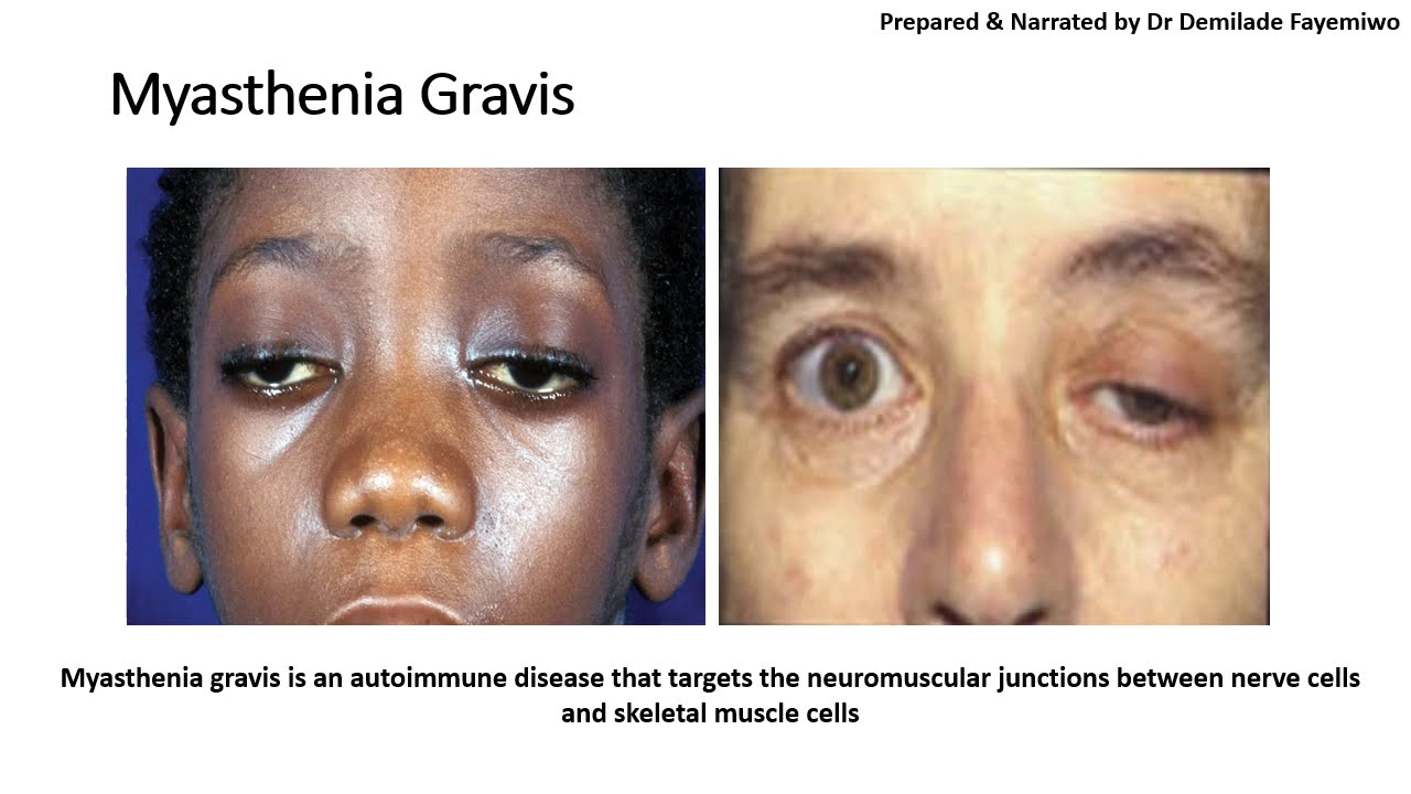 Chapter 11.4: Autoimmune Diseases and Monoclonal Antibodies
