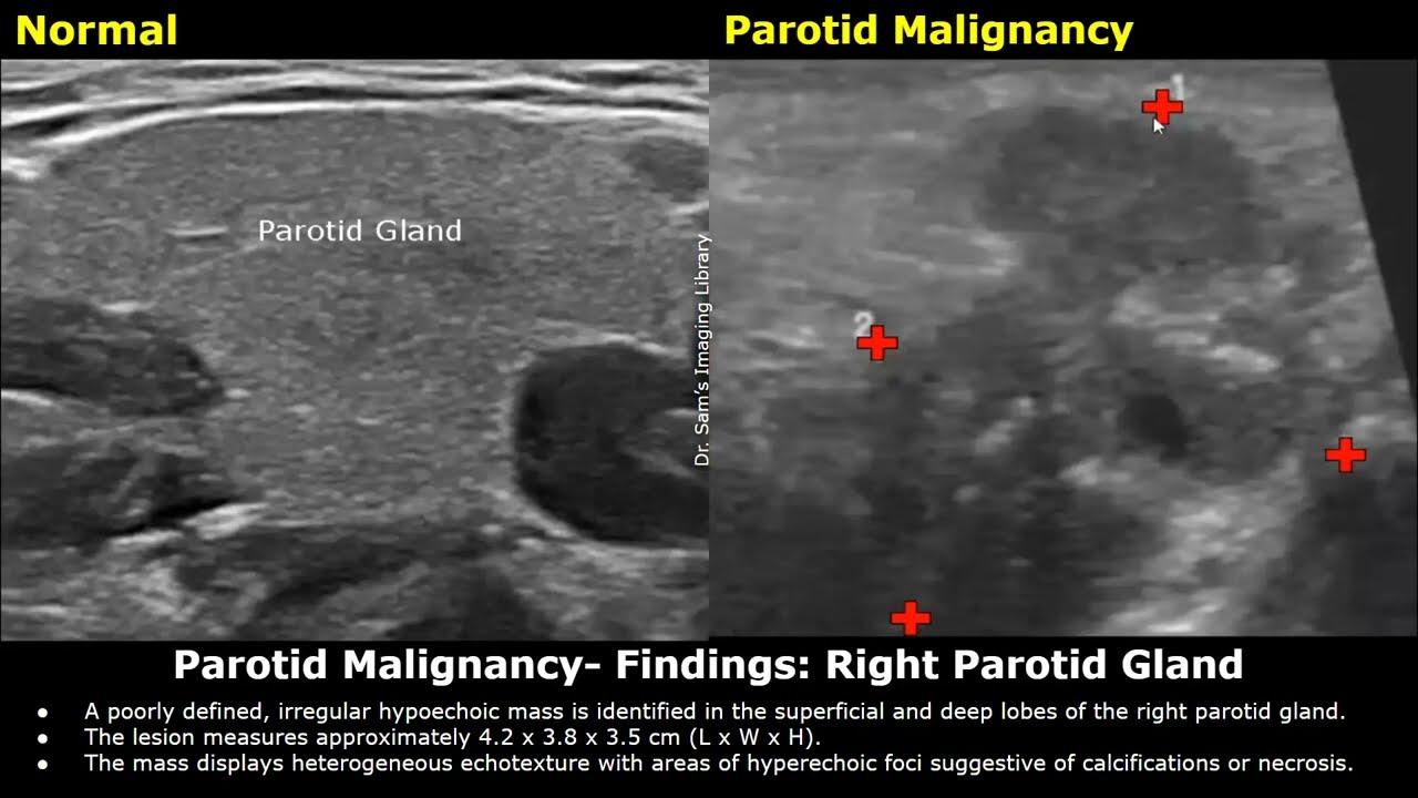 Salivary Glands Ultrasound Reporting | Sialolithiasis, Sialadenitis, Sjogren Syndrome, Parotid USG