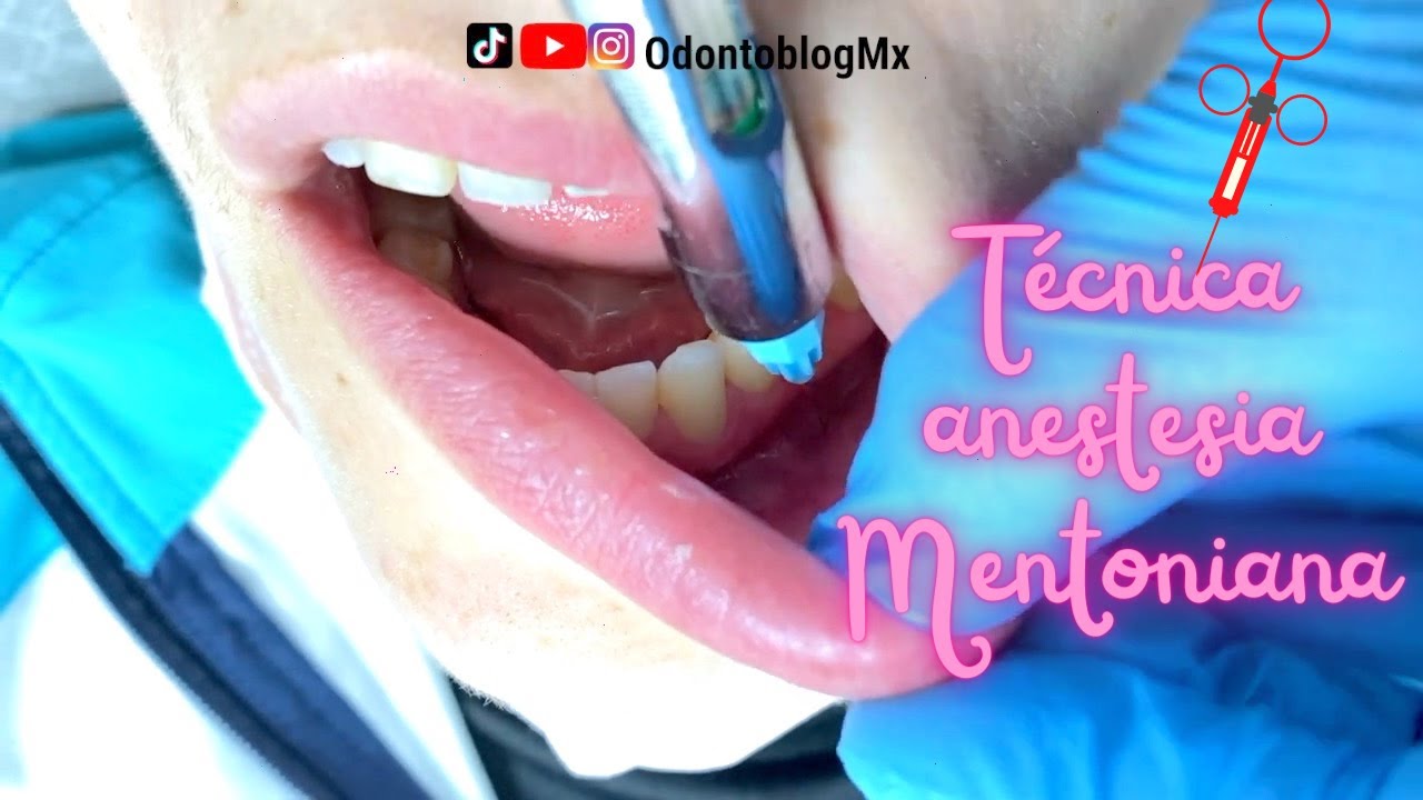 Técnica Mentoniana  💉