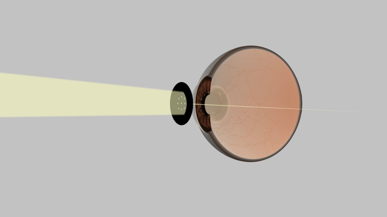 Pinhole Occluder Use in Visual Acuity Testing