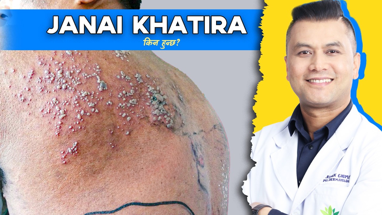 Herpes Zoster Explained | Janai Khatira किन हुन्छ? Symptoms, Treatment & Myths | Dr. Rupak