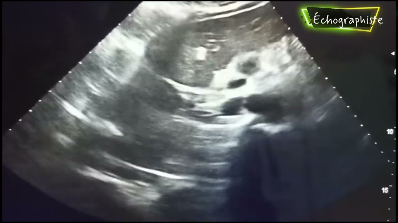 Échographie abdominale: lesion focale du pancréas