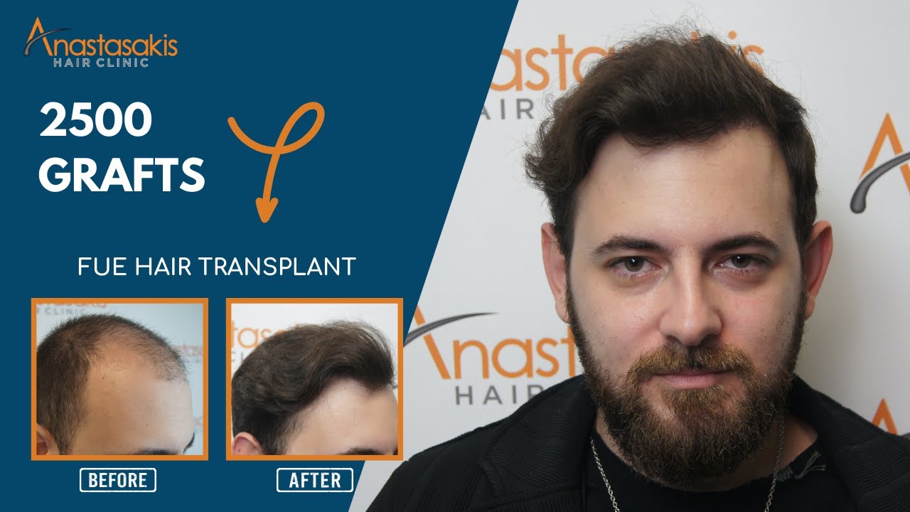 Case #250b: H απίστευτη Μεταμόσχευση Μαλλιών του Βασίλη Καραμανίδη - FUE | 11 Μήνες Αργότερα!  🌟✨