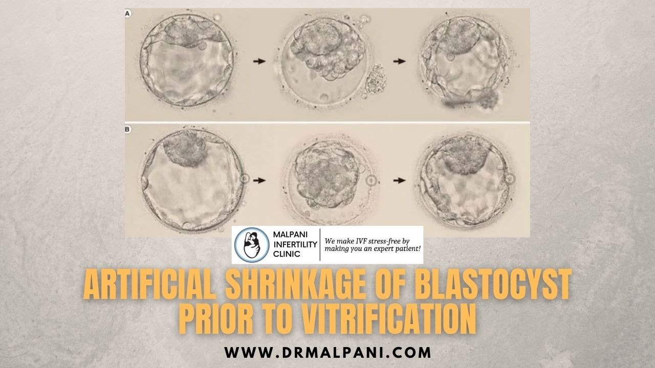 Laser Assited Collapsing of Blastocysts Prior to Vitrification.  #blastocysvitrification #drmalpani