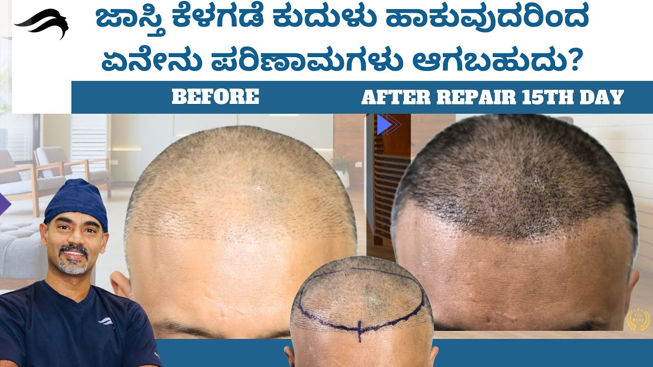Hair Transplant In Bangalore | Best Doctor Center & Clinic Of Hair Transplant In Bangalore