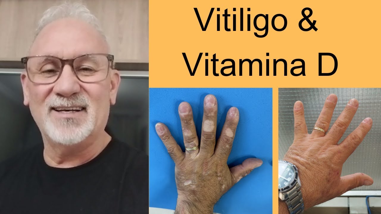 Valdemir - Vitiligo #1080