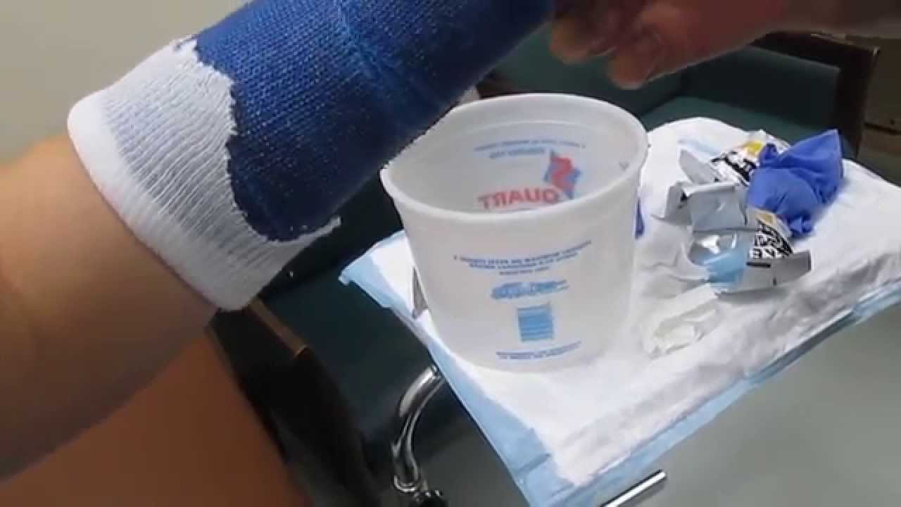 getting a cast put on