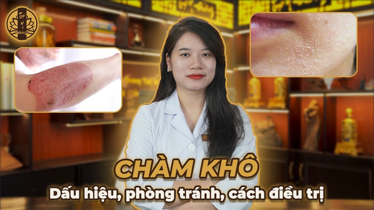CHÀM KHÔ - DẤU HIỆU NHẬN BIẾT BIỆNH, HƯỚNG ĐIỀU TRỊ CHÀM KHÔ HIỆU QUẢ