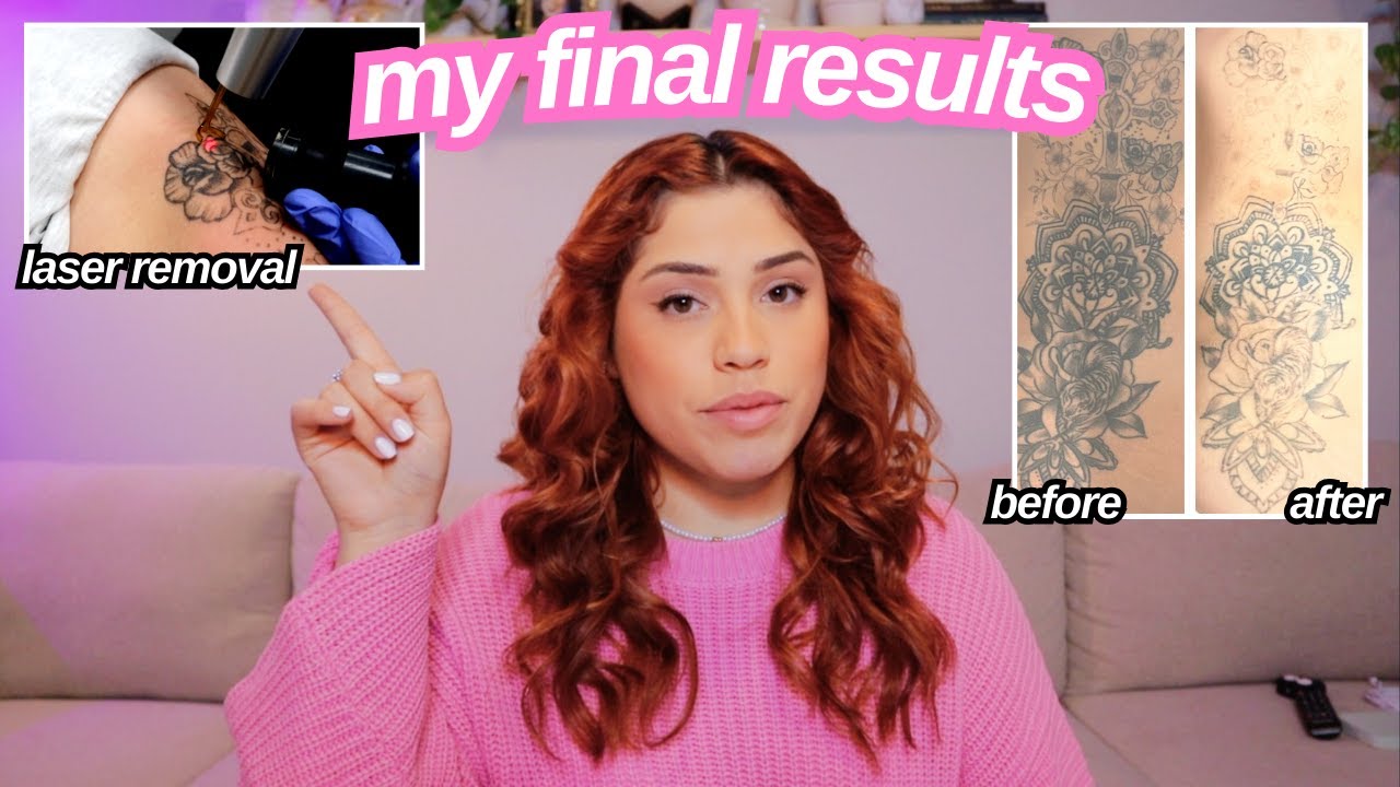 Final Results After 3 Sessions & What’s Next | Tattoo Removal Part 6