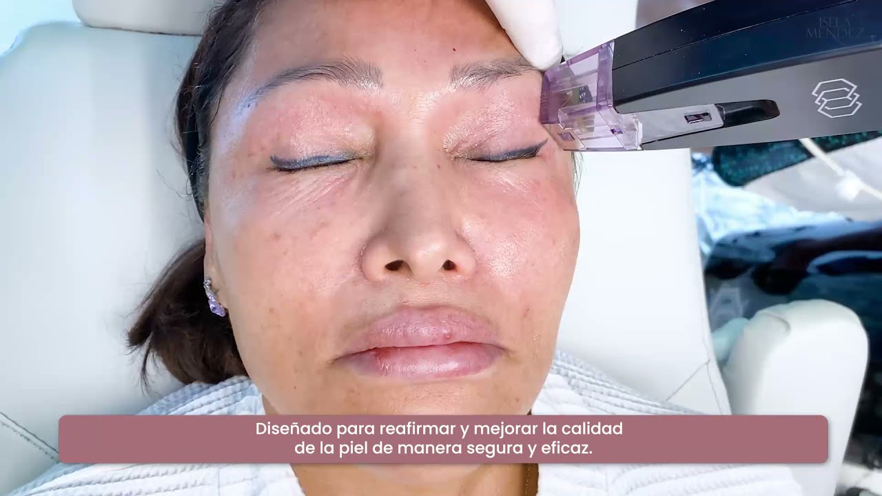 Morpheus 8, &iquest;qu&eacute; es y para qu&eacute; sirve? // 👩🏻&zwj;⚕️✨