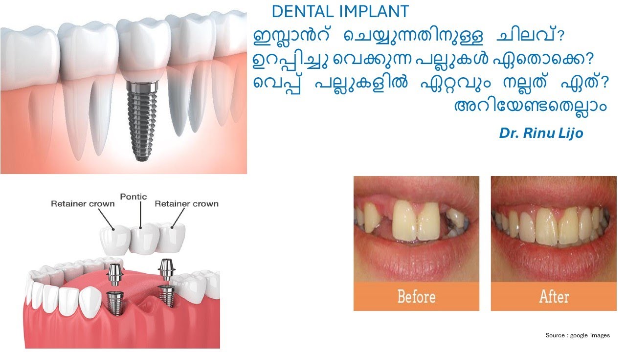 Dental implant - ചിലവ്, ഉറപ്പിച്ചു വെക്കുന്ന പല്ലുകളിൽ  നല്ലത് ഏതാണ്? Dr.Rinu Lijo