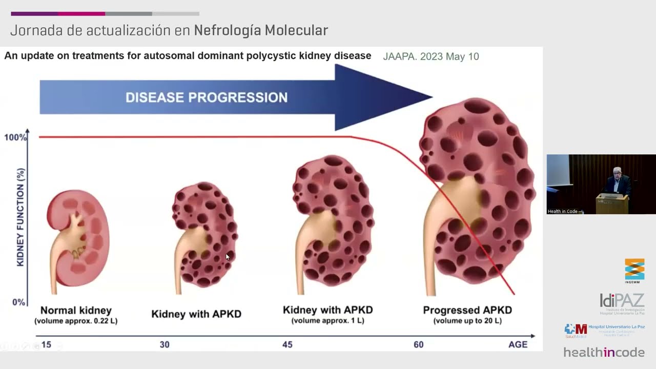 Poliquistosis renal autosómica dominante: actualidad y perspectivas | 👨‍⚕️ Dr. Ramón Peces Serrano