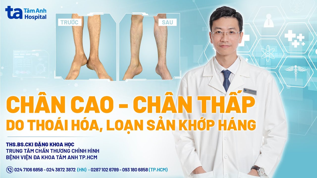 Chân cao - Chân thấp do thoái hóa, loạn sản khớp háng | ThS.BS.CKI Đặng Khoa Học | CTCH Tâm Anh