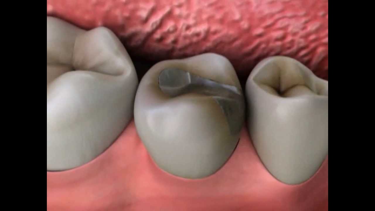 Restoration Overhang | Lake Merritt Dental, Oakland, CA