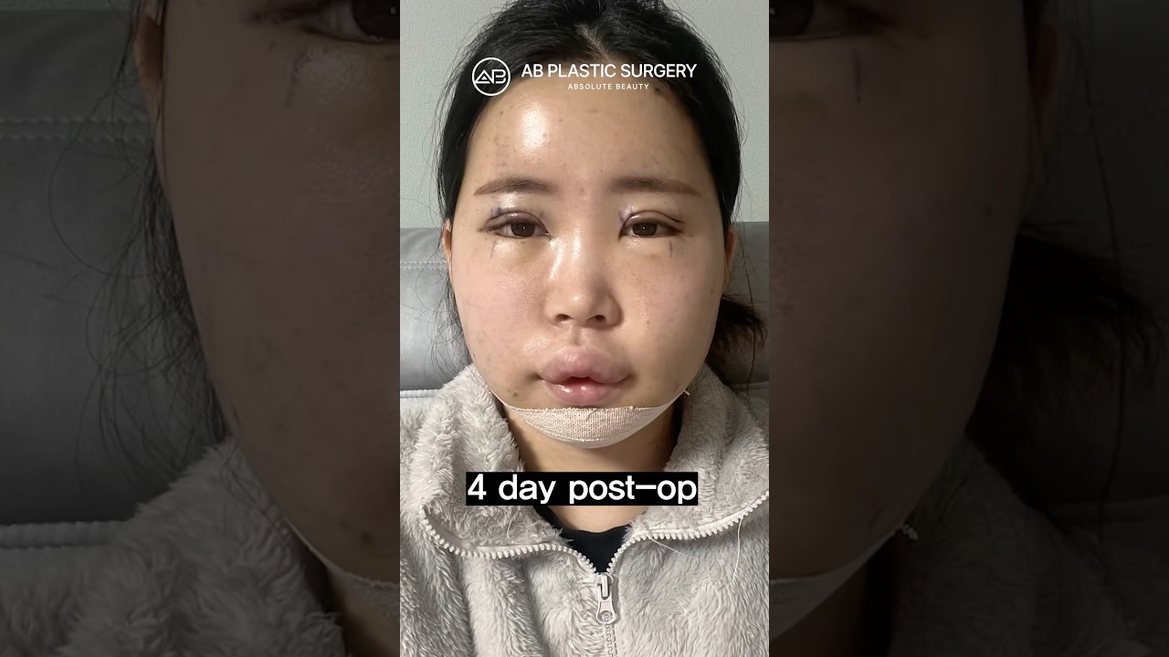 Facial contouring+Double eyelid surgery #koreanplasticsurgery