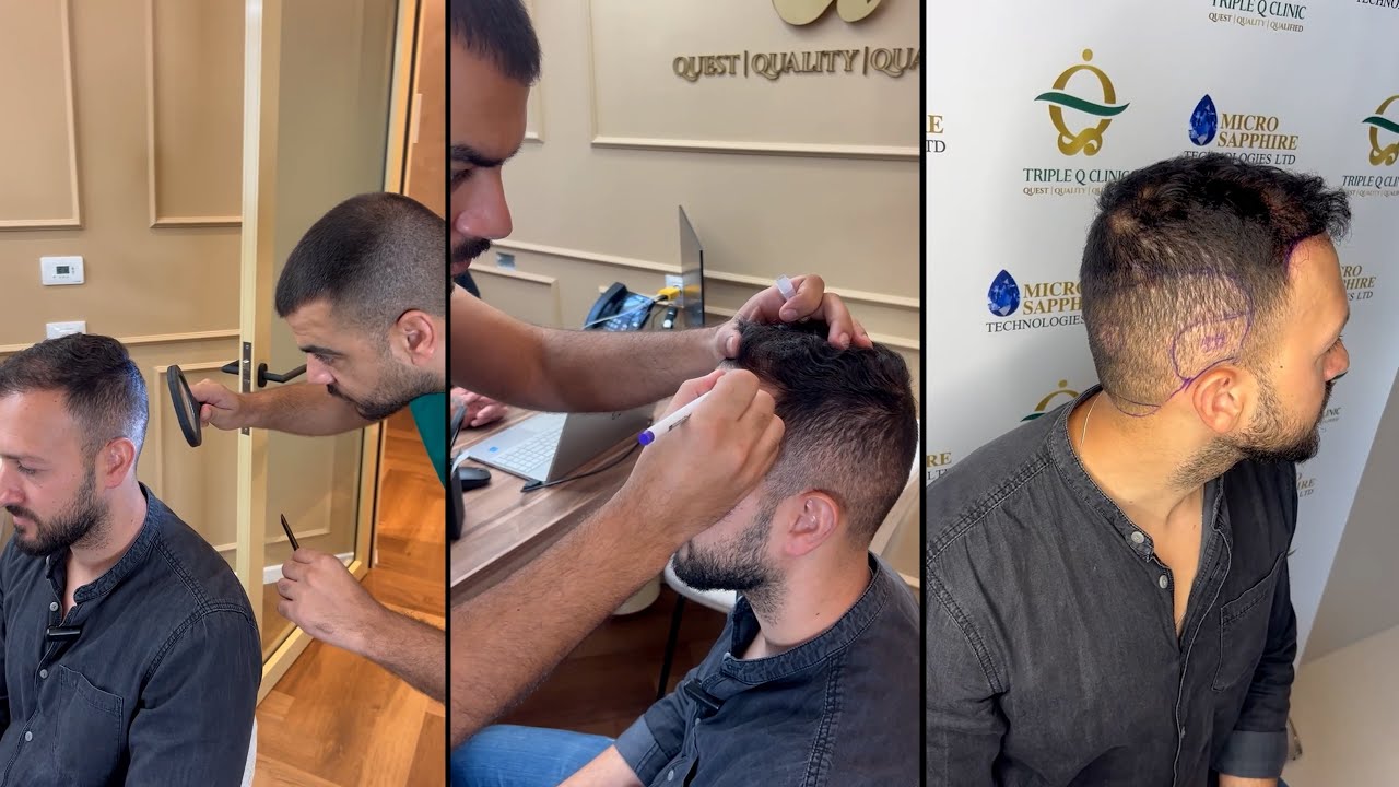הכירו את Triple Q Clinic - השתלת שיער שמביאה את טורקיה לישראל בהכשרת ד״ר אקאר! (מקוצר)
