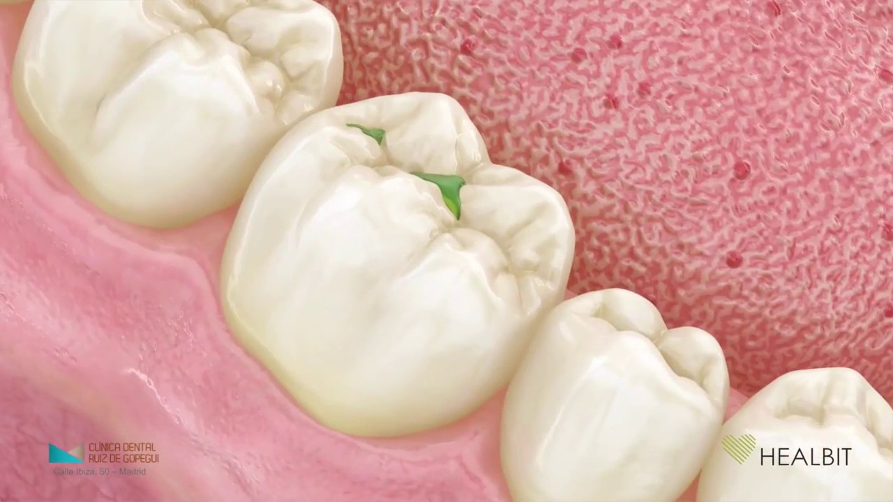 ¿Qué son las caries?