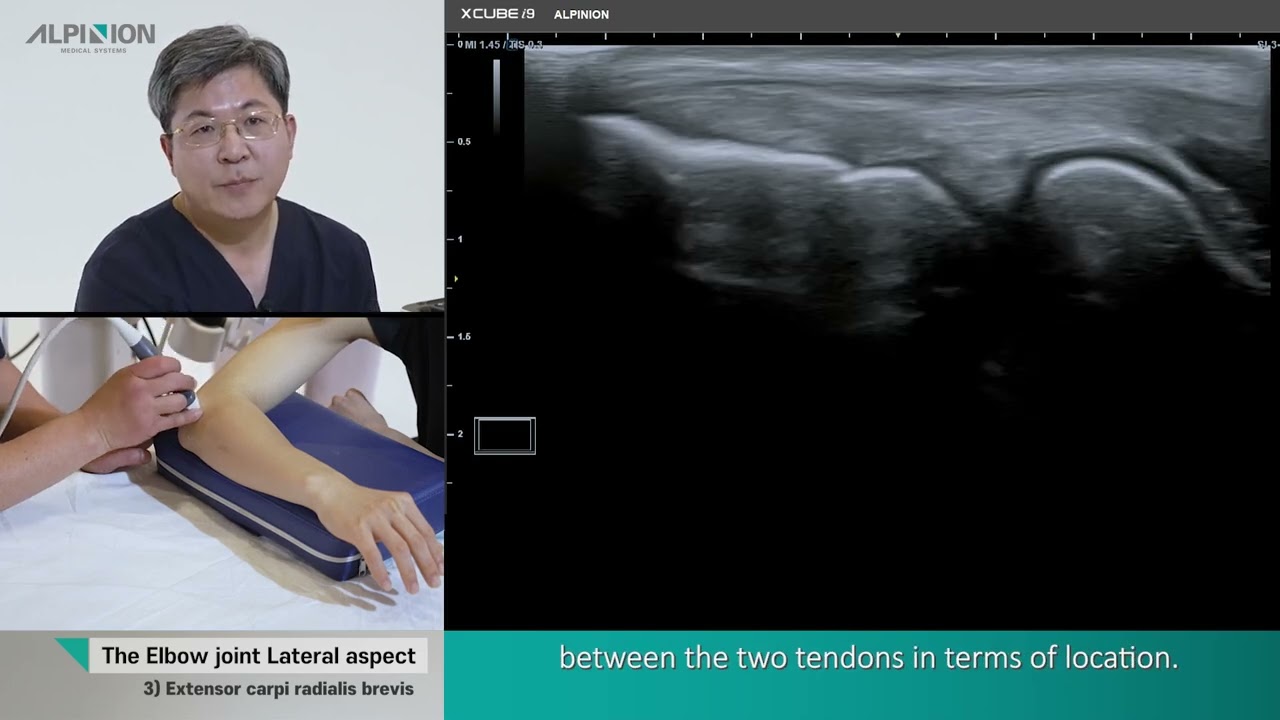 Musculoskeletal Ultrasound (Elbow) 03.Lateral aspect