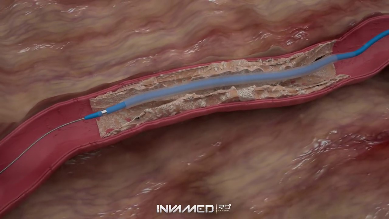 EXTENDER®️ Paclitaxel Coated PTA Balloon Catheter