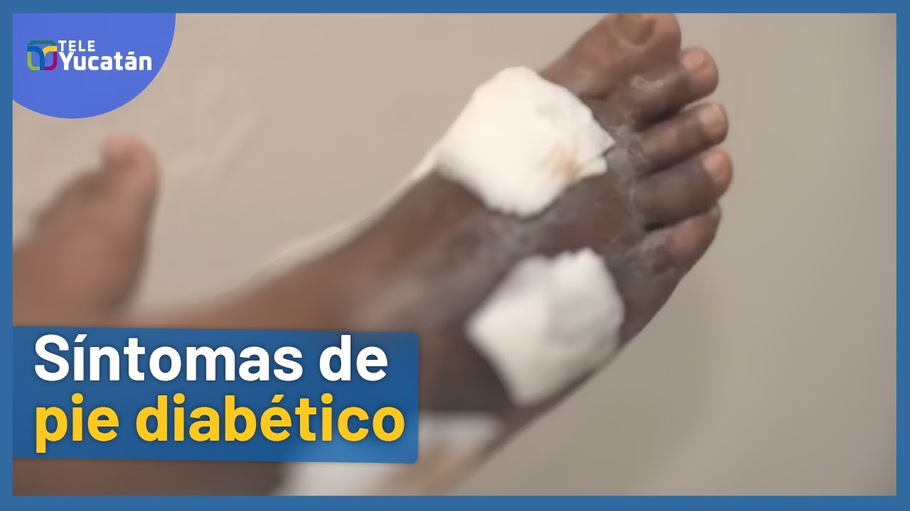 👉S&iacute;ntomas de PIE DIAB&Eacute;TICO🦶 | VIDEOS de prevenci&oacute;n y cuidados 2022 | TELE Yucat&aacute;n