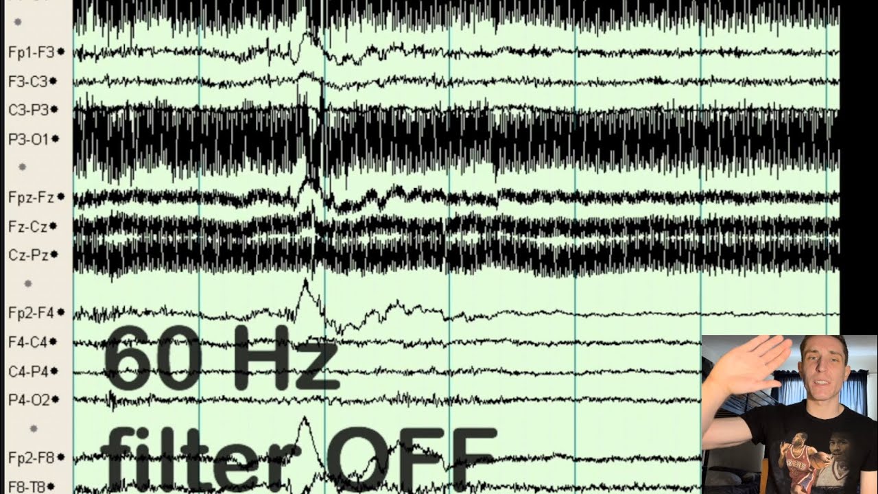 EEG Filters (HFF, LFF, Notch, Artifact)