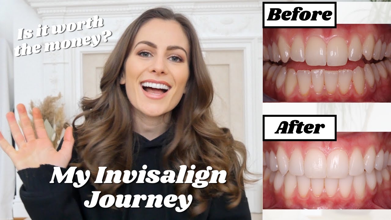 INVISALIGN JOURNEY | Before & After - Is it worth it?