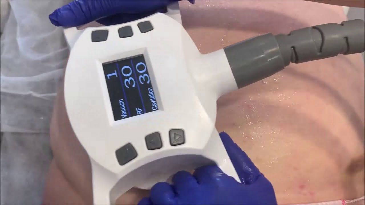 Endermologia Magnifico II Premium na brzuch i boki