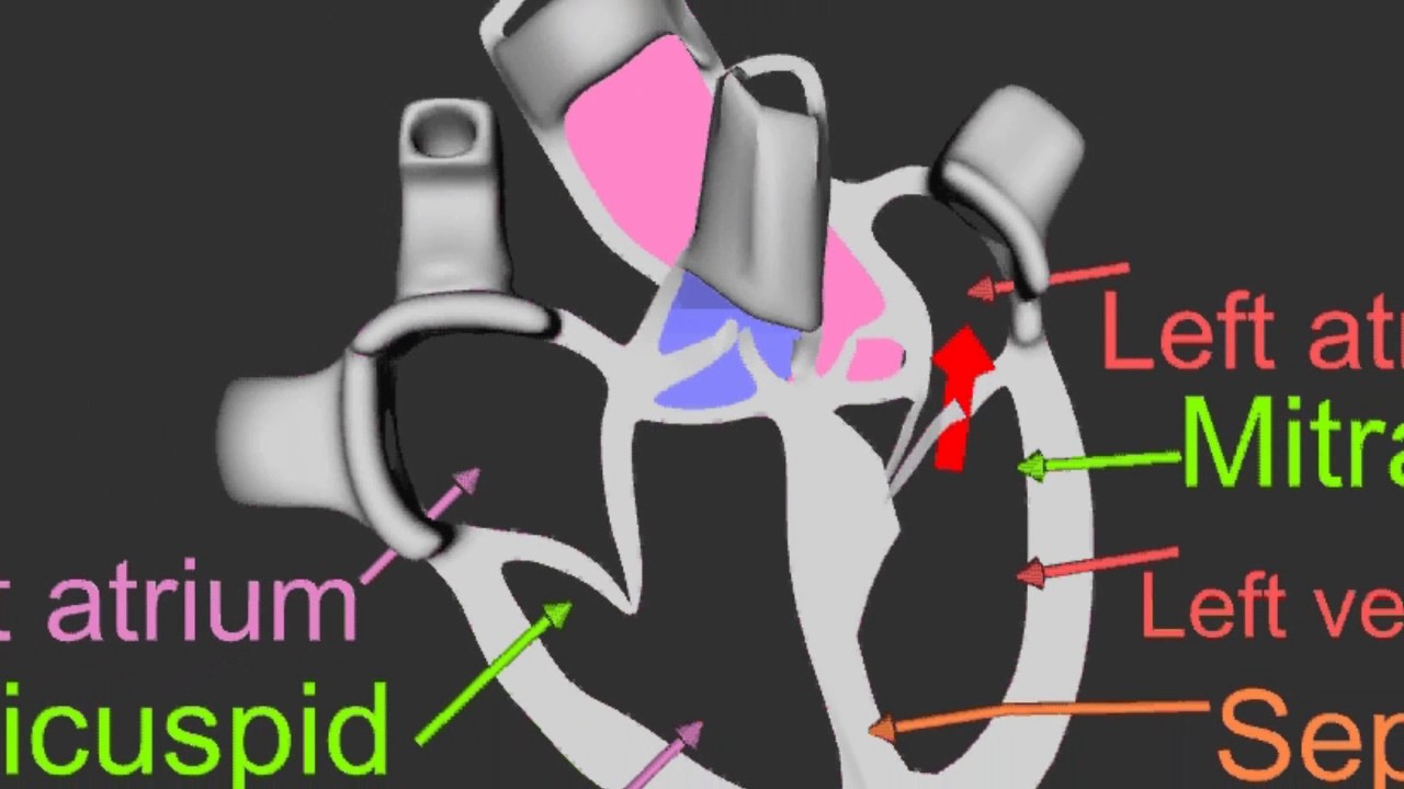 HOCM Untreated Part 3 VENTURI effect-Mitral valve damage