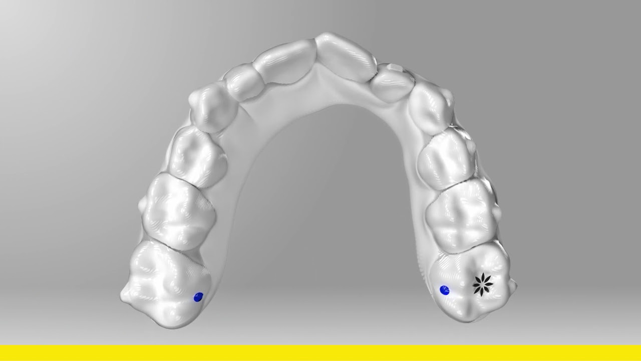 Invisalign First Howitworks Ortho SmileMed