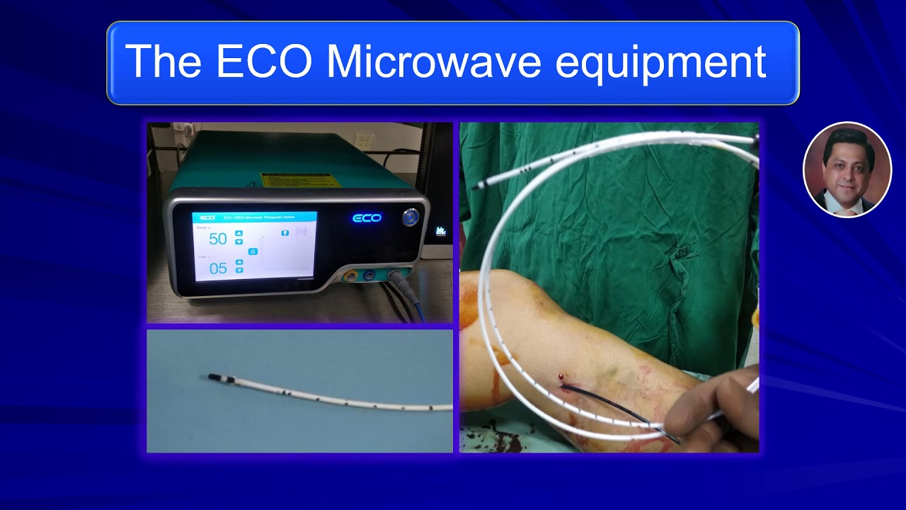 Microwave Treatment for Varicose Veins - Dr Shoaib Padaria