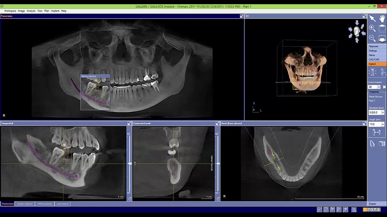Galileos Galaxis Basics 6: Basic Implant Planning