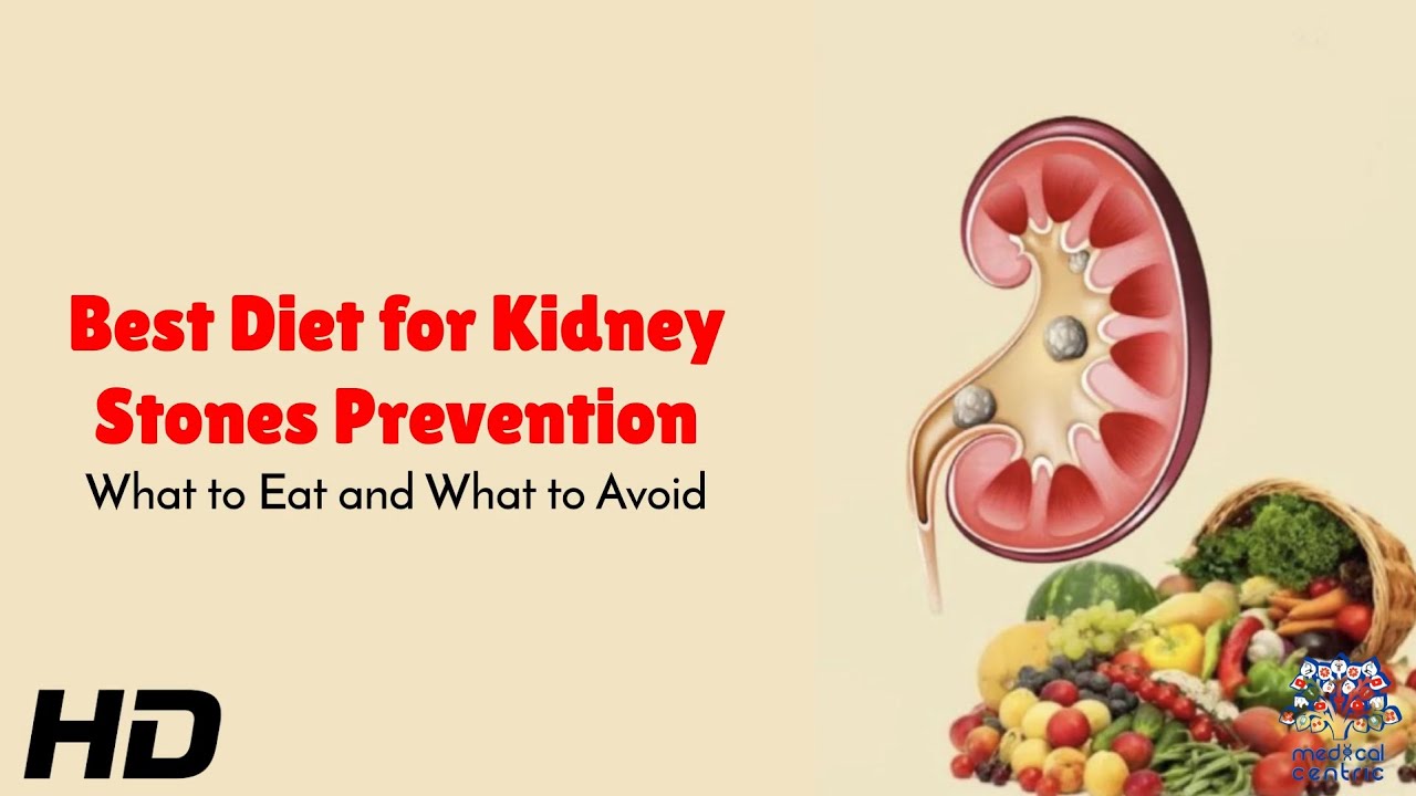 Best Diet for Kidney Stones Prevention Expert Tips on Eating Right