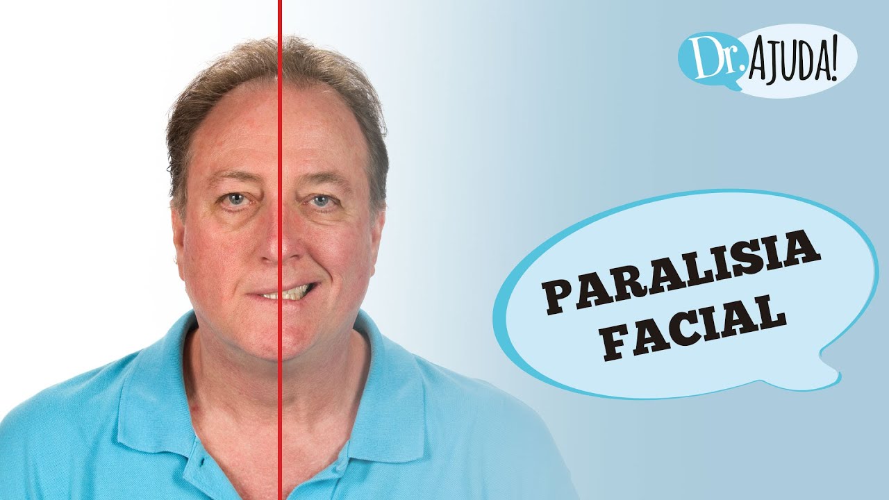 PARALISIA FACIAL: O QUE &Eacute;, SINTOMAS, DIAGN&Oacute;STICO, CAUSAS E TRATAMENTO