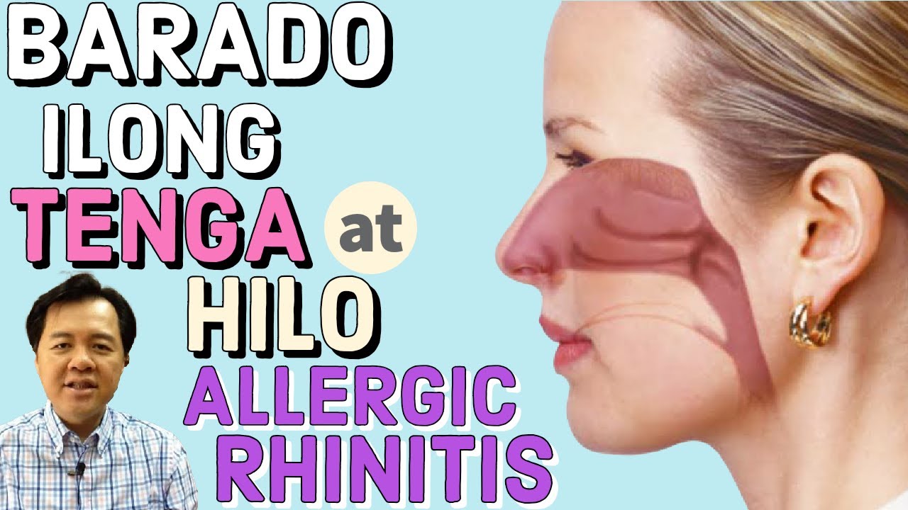 Barado Ilong, Tenga at Hilo: Allergic Rhinitis – by Doc Willie Ong