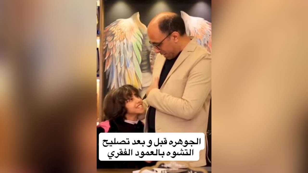 الجوهرة قبل و بعد تصليح التشوه بالعمود الفقري