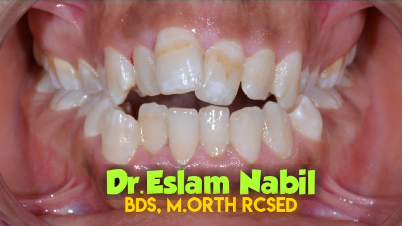 Skeletal Open bite Camouflage - Molars Intrusion by TADs - علاج العضه المفتوحه بروز ازدحام الاسنان